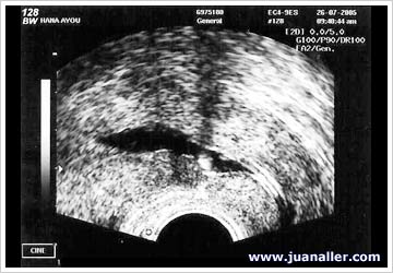 Pólipo segmento uterino postoperatorio