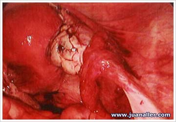Endometriosis ovárica